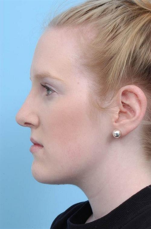 Rhinoplasty After Photo | Miami, FL | Baker Plastic Surgery