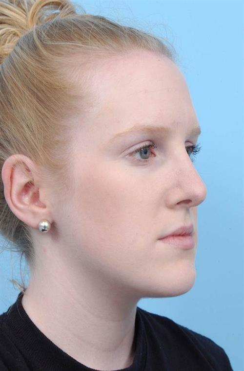 Rhinoplasty After Photo | Miami, FL | Baker Plastic Surgery