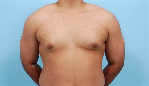 Gynecomastia Before Photo | Miami, FL | Baker Plastic Surgery