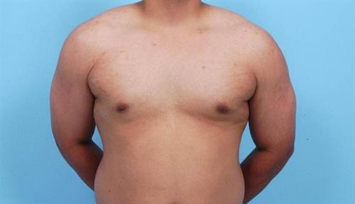 Gynecomastia After Photo | Miami, FL | Baker Plastic Surgery