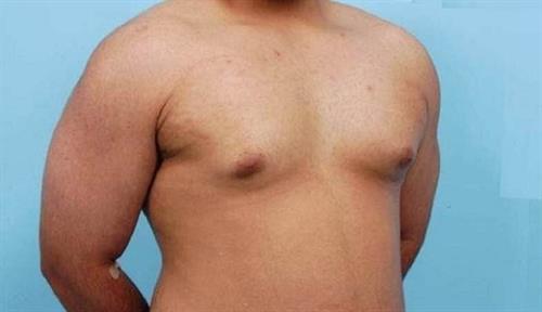 Gynecomastia Before Photo | Miami, FL | Baker Plastic Surgery