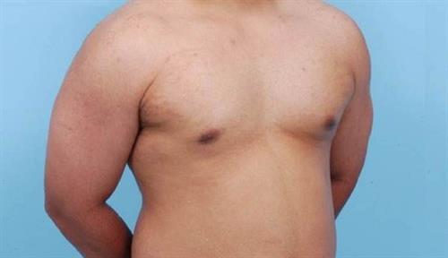 Gynecomastia After Photo | Miami, FL | Baker Plastic Surgery