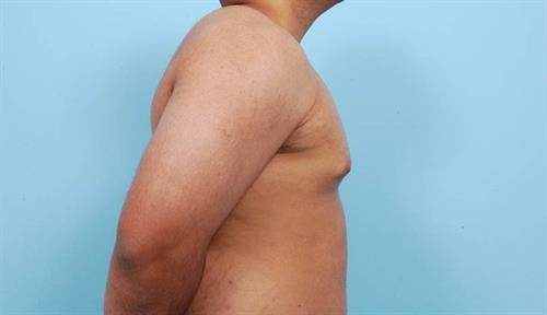 Gynecomastia Before Photo | Miami, FL | Baker Plastic Surgery