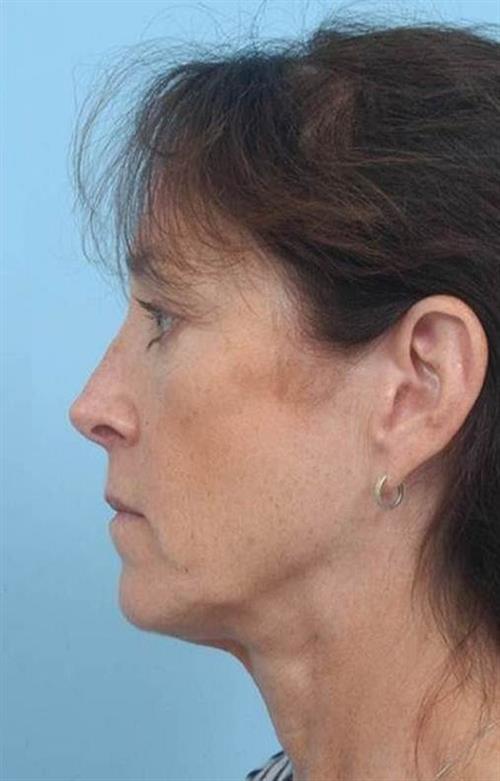 Facelift & Neck Lift Before Photo | Miami, FL | Baker Plastic Surgery