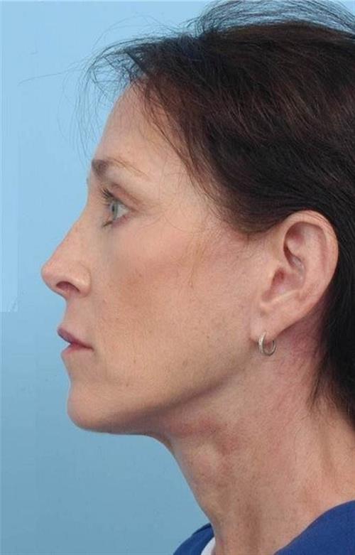 Facelift & Neck Lift After Photo | Miami, FL | Baker Plastic Surgery