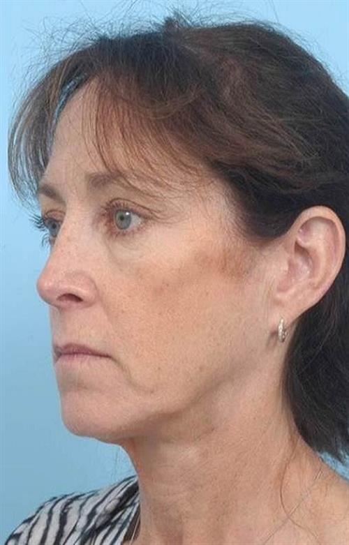 Facelift & Neck Lift Before Photo | Miami, FL | Baker Plastic Surgery