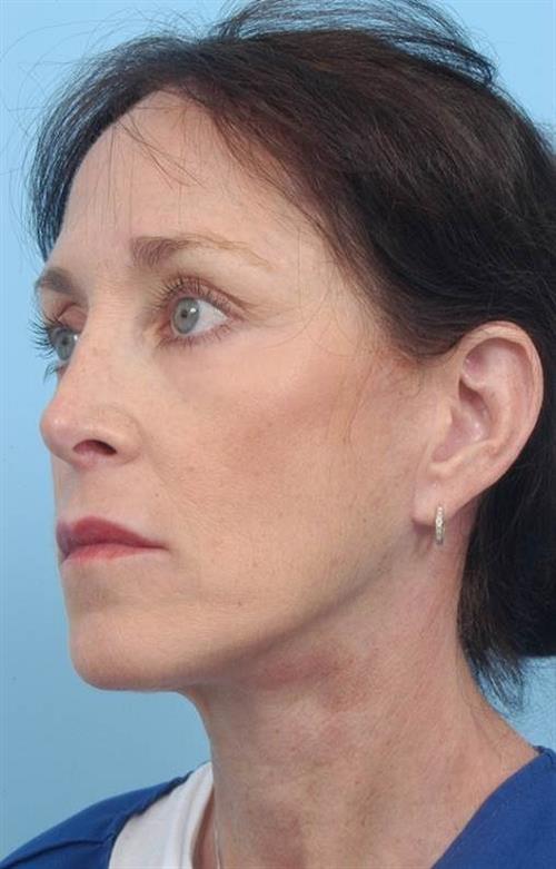 Facelift & Neck Lift After Photo | Miami, FL | Baker Plastic Surgery