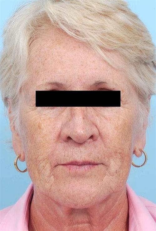 Facelift & Neck Lift Before Photo | Miami, FL | Baker Plastic Surgery