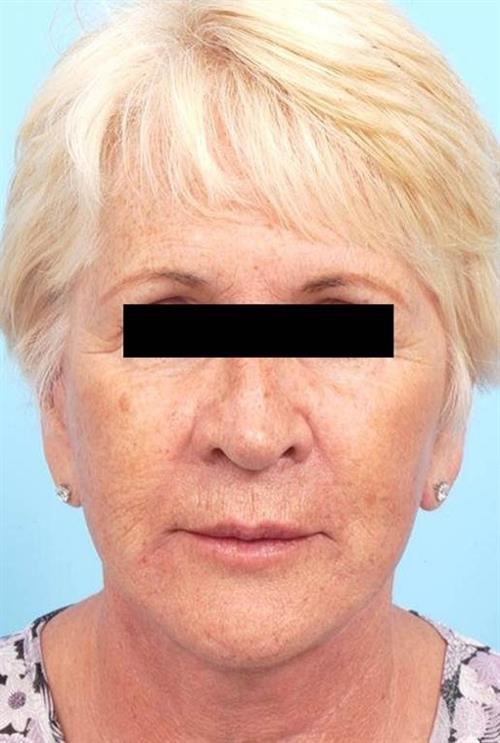 Facelift & Neck Lift After Photo | Miami, FL | Baker Plastic Surgery