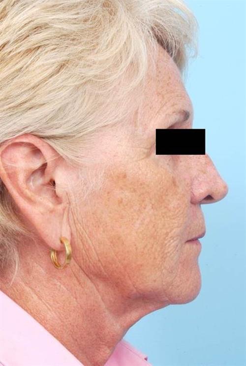 Facelift & Neck Lift Before Photo | Miami, FL | Baker Plastic Surgery