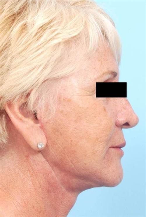 Facelift & Neck Lift After Photo | Miami, FL | Baker Plastic Surgery