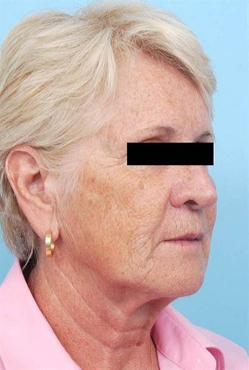 Facelift & Neck Lift Before Photo | Miami, FL | Baker Plastic Surgery