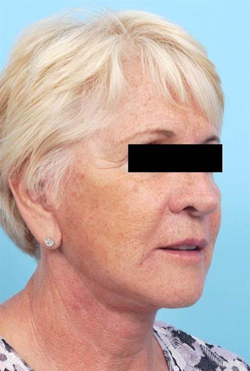 Facelift & Neck Lift After Photo | Miami, FL | Baker Plastic Surgery