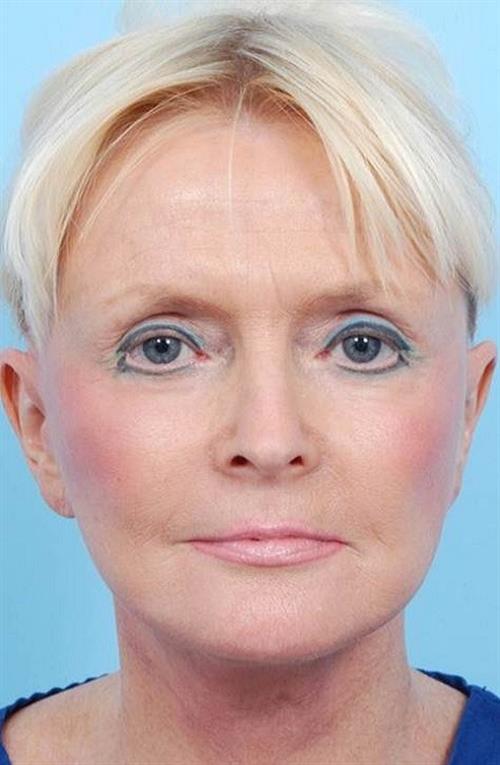 Facelift & Neck Lift After Photo | Miami, FL | Baker Plastic Surgery