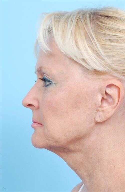 Facelift & Neck Lift Before Photo | Miami, FL | Baker Plastic Surgery