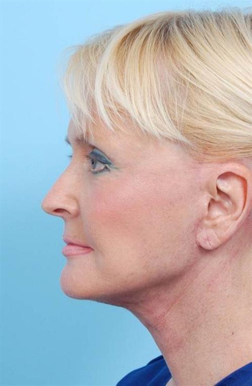 Facelift & Neck Lift After Photo | Miami, FL | Baker Plastic Surgery