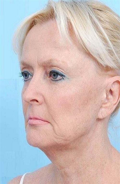 Facelift & Neck Lift Before Photo | Miami, FL | Baker Plastic Surgery