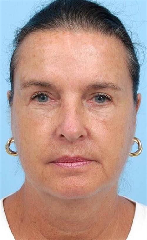 Facelift & Neck Lift Before Photo | Miami, FL | Baker Plastic Surgery