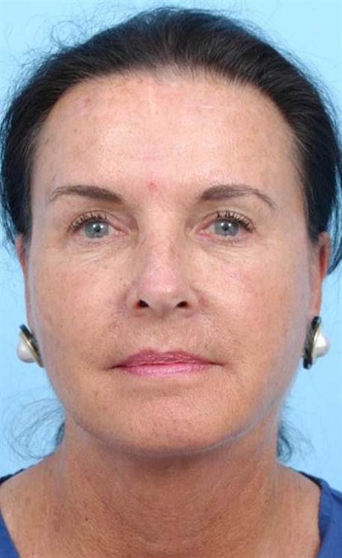 Facelift & Neck Lift After Photo | Miami, FL | Baker Plastic Surgery