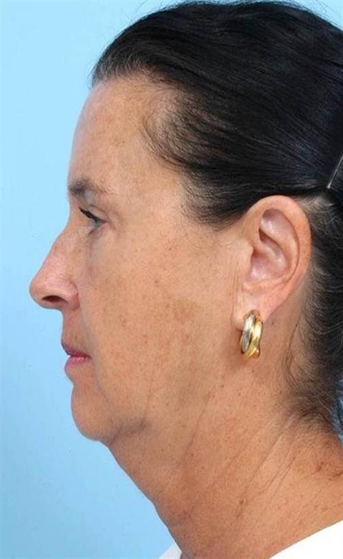 Facelift & Neck Lift Before Photo | Miami, FL | Baker Plastic Surgery