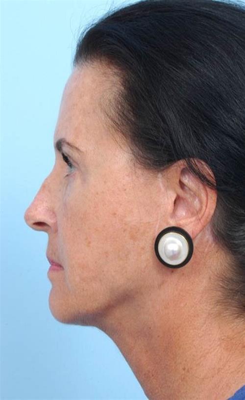 Facelift & Neck Lift After Photo | Miami, FL | Baker Plastic Surgery