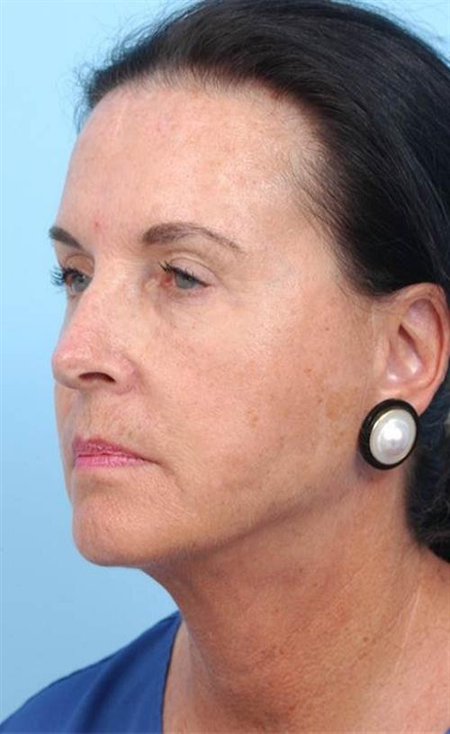 Facelift & Neck Lift After Photo | Miami, FL | Baker Plastic Surgery