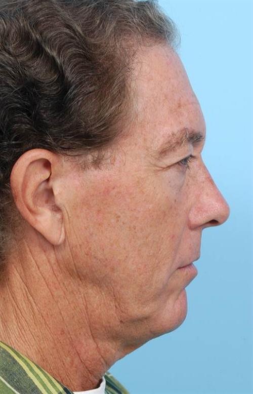 Facelift & Neck Lift Before Photo | Miami, FL | Baker Plastic Surgery