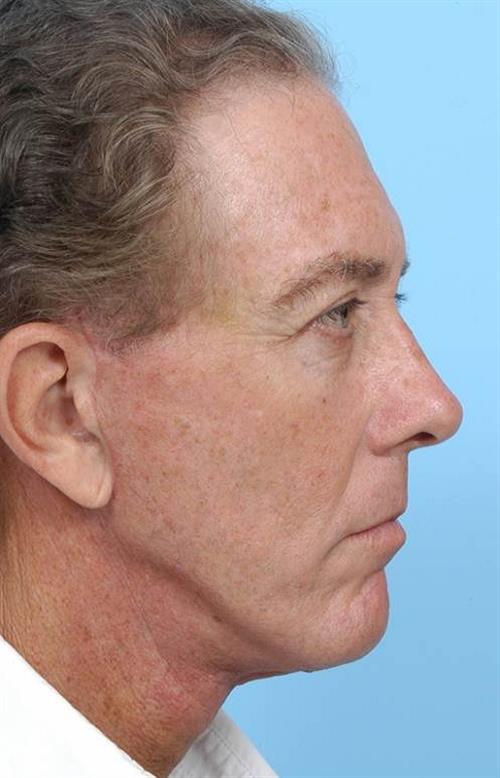 Facelift & Neck Lift After Photo | Miami, FL | Baker Plastic Surgery