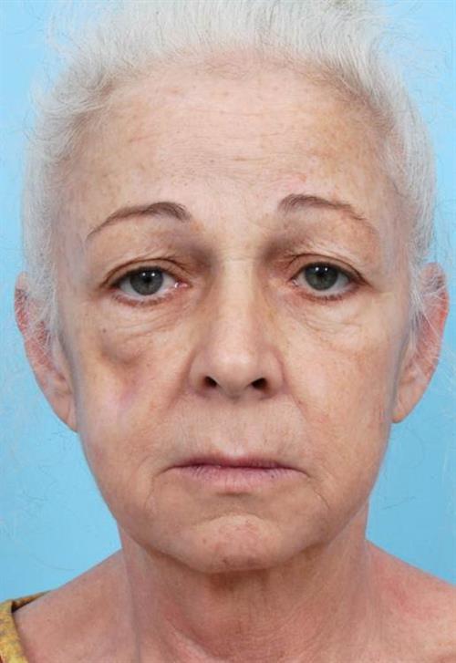 Facelift & Neck Lift Before Photo | Miami, FL | Baker Plastic Surgery