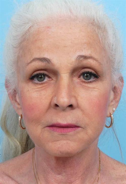 Facelift & Neck Lift After Photo | Miami, FL | Baker Plastic Surgery