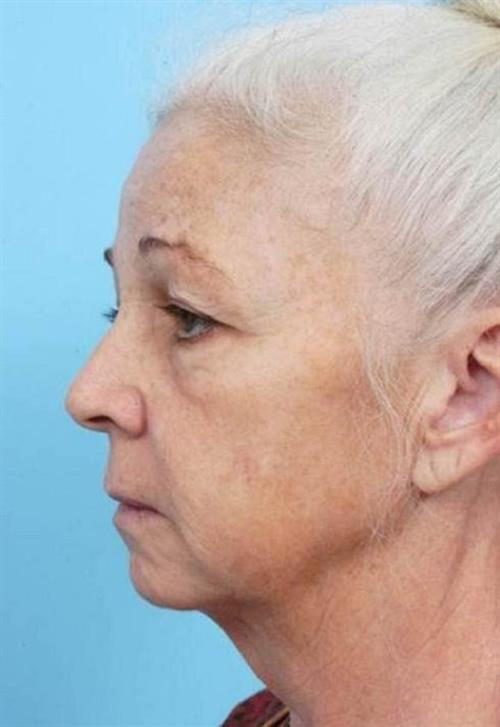 Facelift & Neck Lift Before Photo | Miami, FL | Baker Plastic Surgery