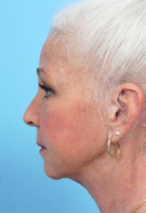 Facelift & Neck Lift After Photo | Miami, FL | Baker Plastic Surgery