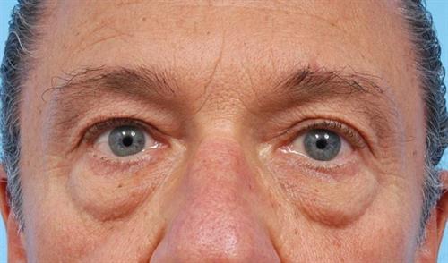 Eyelid Surgery Before Photo | Miami, FL | Baker Plastic Surgery