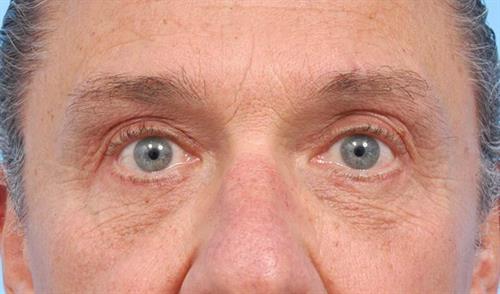 Eyelid Surgery After Photo | Miami, FL | Baker Plastic Surgery