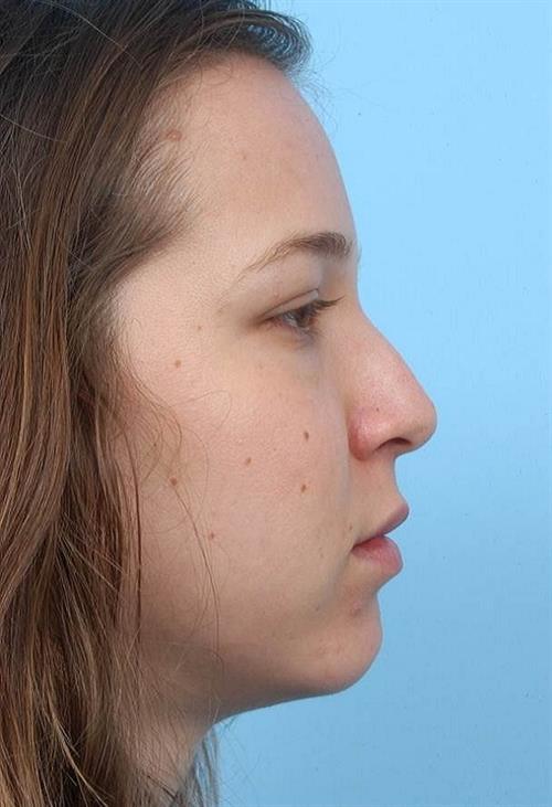 Rhinoplasty Before Photo | Miami, FL | Baker Plastic Surgery