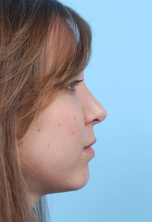 Rhinoplasty After Photo | Miami, FL | Baker Plastic Surgery