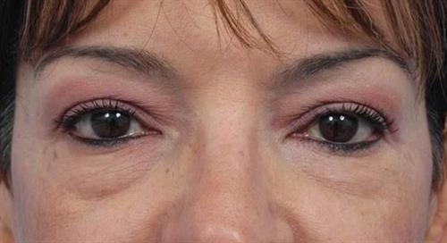 Eyelid Surgery Before Photo | Miami, FL | Baker Plastic Surgery