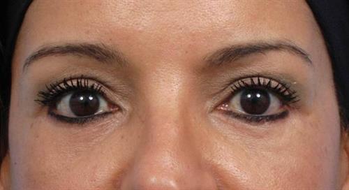 Eyelid Surgery After Photo | Miami, FL | Baker Plastic Surgery