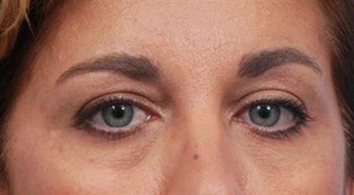 Eyelid Surgery Before Photo | Miami, FL | Baker Plastic Surgery