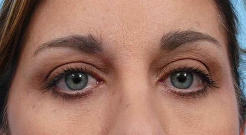 Eyelid Surgery After Photo | Miami, FL | Baker Plastic Surgery