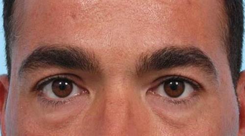 Eyelid Surgery Before Photo | Miami, FL | Baker Plastic Surgery