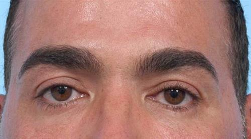 Eyelid Surgery After Photo | Miami, FL | Baker Plastic Surgery