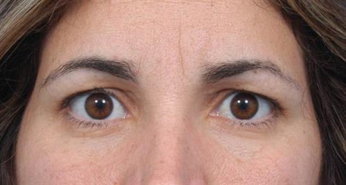 Eyelid Surgery Before Photo | Miami, FL | Baker Plastic Surgery