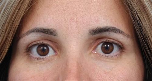 Eyelid Surgery After Photo | Miami, FL | Baker Plastic Surgery