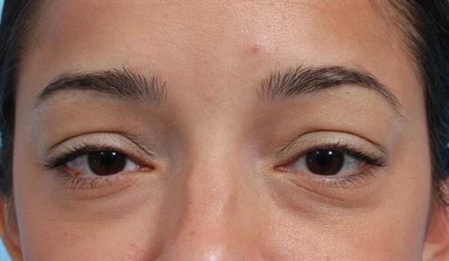 Eyelid Surgery Before Photo | Miami, FL | Baker Plastic Surgery