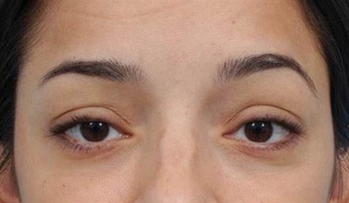 Eyelid Surgery After Photo | Miami, FL | Baker Plastic Surgery