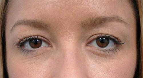 Eyelid Surgery Before Photo | Miami, FL | Baker Plastic Surgery