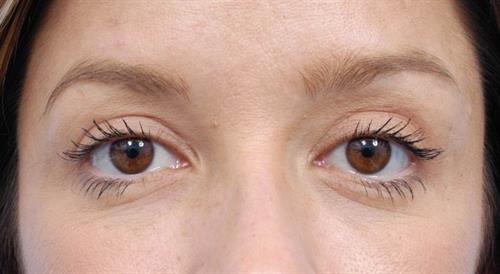 Eyelid Surgery After Photo | Miami, FL | Baker Plastic Surgery