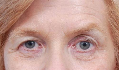 Eyelid Surgery Before Photo | Miami, FL | Baker Plastic Surgery