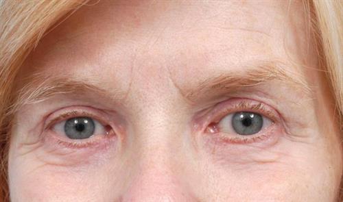 Eyelid Surgery After Photo | Miami, FL | Baker Plastic Surgery